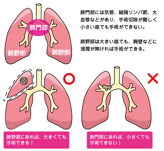 肺がん手術