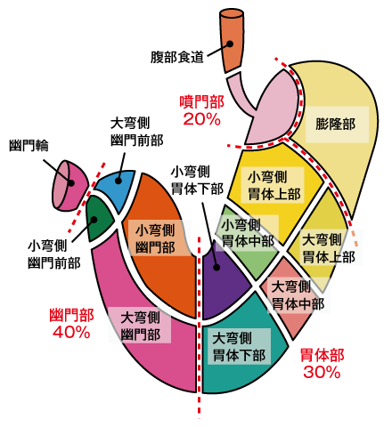 胃癌の発生部位