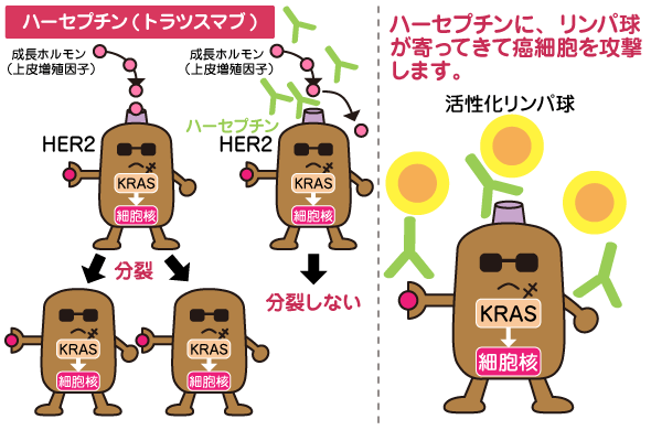 胃癌 ハーセプチン