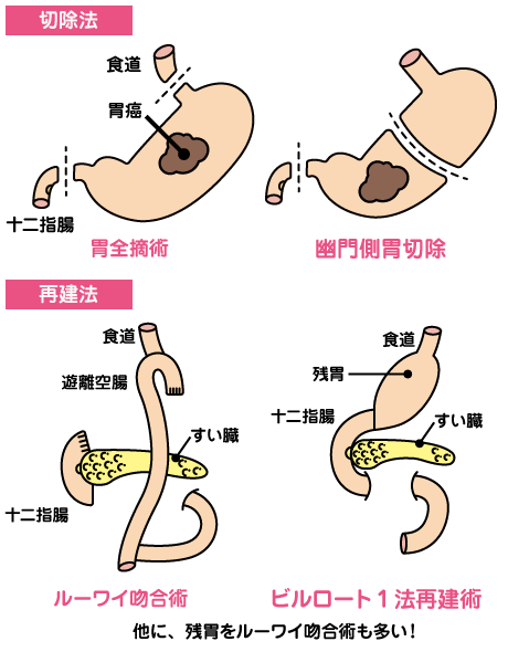 胃がんの手術 | 新横浜かとうクリニック