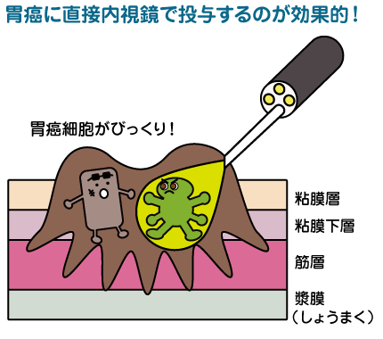 胃癌 局所樹状細胞がんワクチン