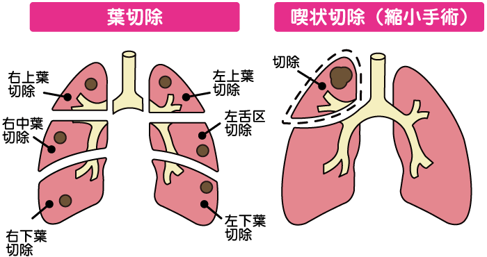 肺癌ステージ2