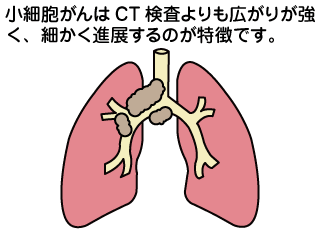 肺がんの手術